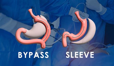 Diagrama comparativo das técnicas de cirurgia bariátrica: Sleeve Gástrico e Bypass Gástrico