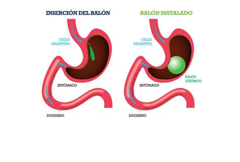infografía explicando el funcionamiento del balón gástrico en el estómago