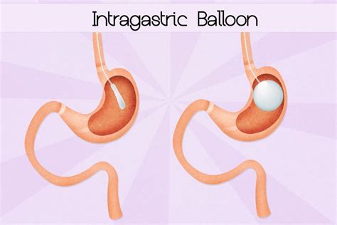 comparativa visual de un balón gástrico endoscópico y un balón gástrico ingerible (cápsula)