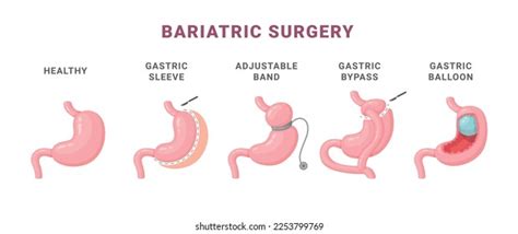 esquema comparativo de diferentes tipos de cirugía bariátrica