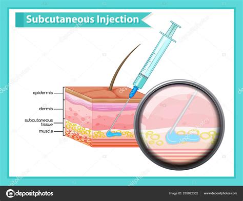 Ilustración de un dispositivo de inyección subcutánea, similar a los utilizados para liraglutida o semaglutida.