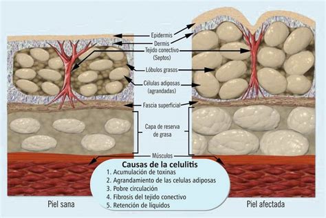Comparativa visual de piel con hoyuelos (aspecto similar a la celulitis) y piel lisa tras una liposucción exitosa.