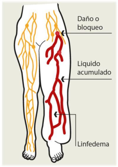 Diagrama que ilustra la acumulación de linfa en el linfedema y la piel de naranja característica de la celulitis.