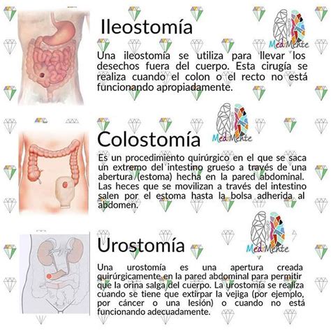 Diagrama que muestra la diferencia entre colostomía e ileostomía