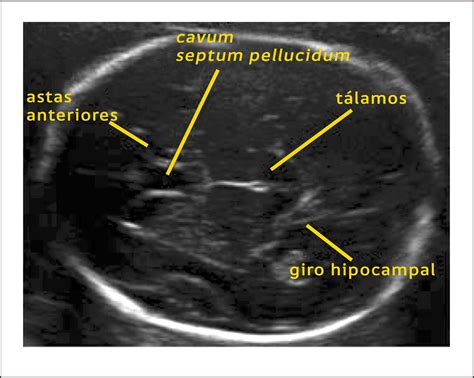 Ecografía fetal mostrando mediciones de la cabeza y el abdomen
