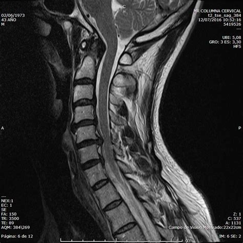 Imagen de resonancia magnética (RM) cervical mostrando una hernia discal C6-C7 con compresión radicular.