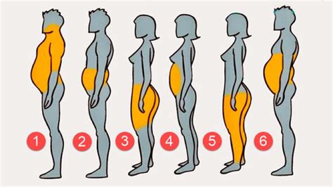 Diagrama anatómico que muestra la distribución típica de la grasa localizada en hombres tratada con liposucción.