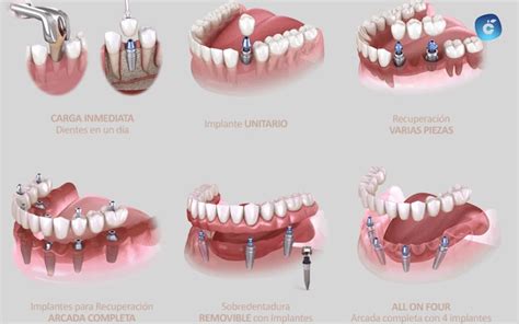 Tabla comparativa de diferentes tipos de implantes hormonales y sus beneficios.