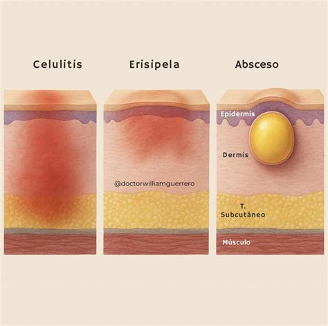 Infografía detallando las capas de la piel afectadas por la celulitis y los factores que contribuyen a su aparición.