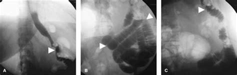 Estudio fluoroscópico con proyecciones anteroposteriores (A y B) y oblicua izquierda (C) de la derivación gástrica en Y de Roux (BPGYR), mostrando el reservorio gástrico, el asa alimentaria y el intestino delgado opacificado.