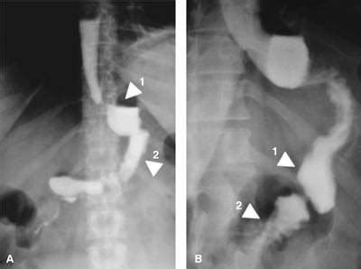 Estudio fluoroscópico con proyecciones anteroposterior (A) y oblicua izquierda (B) de la gastrectomía vertical en manga (GVM).