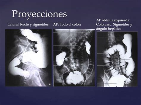Estudio fluoroscópico con proyecciones oblicua izquierda (A y B) y anteroposterior (C) de la derivación gástrica de una anastomosis (BPGUA).