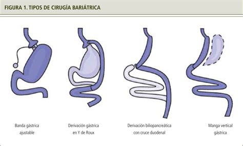 Infografía comparativa de diferentes tipos de cirugía bariátrica