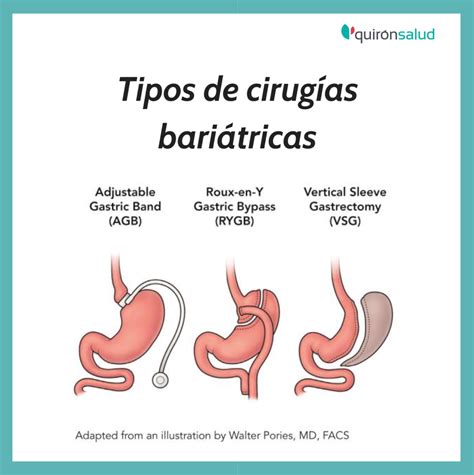 Ilustración de las diferentes técnicas de cirugía bariátrica.