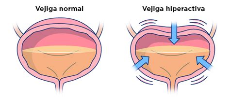 Gráfico de prevalencia del Síndrome de Vejiga Hiperactiva por edad y sexo en España