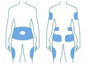 Ilustración mostrando las diferentes zonas del cuerpo donde se puede inyectar insulina.