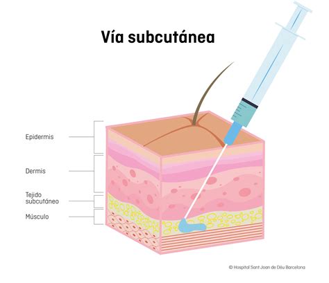 Ilustración esquemática de la aplicación de carboxiterapia en el tejido subcutáneo