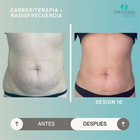 Infografía comparativa de la piel antes y después de carboxiterapia, mostrando mejora en textura y reducción de fibrosis