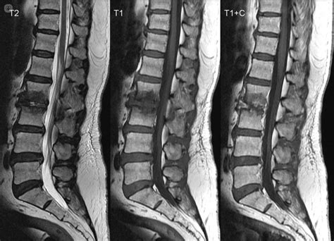 Imagen de resonancia magnética de una columna lumbar, destacando un disco intervertebral herniado.