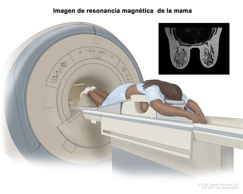 Imagen de resonancia magnética mamaria mostrando un área sospechosa de malignidad.
