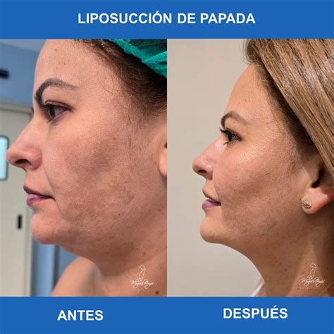 esquema detallado del procedimiento de liposucción de papada, mostrando las incisiones y la cánula