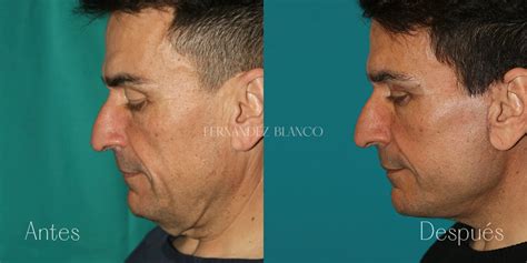 imagen comparativa de antes y después de una liposucción de papada, mostrando la mejora del perfil facial