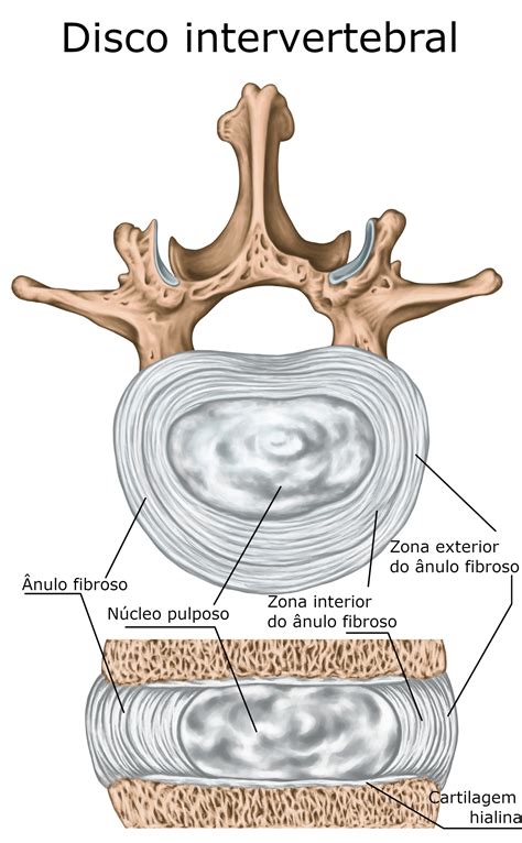 Diagrama anatómico que ilustra la estructura de un disco intervertebral y cómo ocurre una hernia discal.