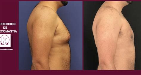 Diagrama comparativo de la ginecomastia y la acumulación de grasa pectoral, mostrando las diferencias en el tacto y la ubicación del tejido.