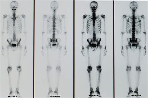 Gammagrafía ósea de cuerpo completo con MDP-99mTc mostrando múltiples depósitos patológicos del trazador en parrillas costales y esternón, así como calcificaciones extraóseas.