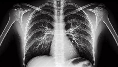 Radiografía de tórax mostrando gran calcificación aórtica.