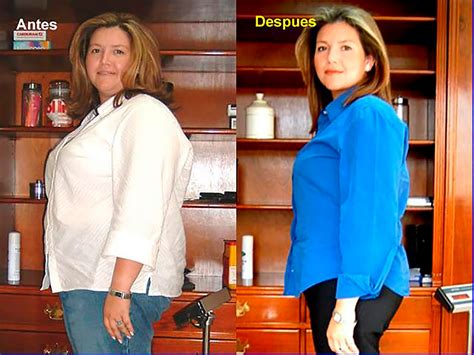 Ilustración comparando el tamaño de un estómago antes y después de la cirugía bariátrica, destacando la reducción de volumen.