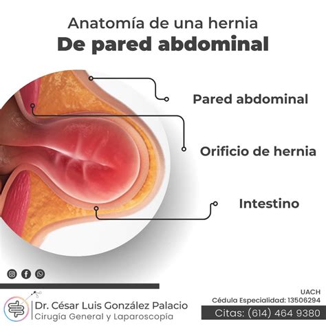 Esquema de una hernia umbilical mostrando la protrusión del intestino a través de la pared abdominal