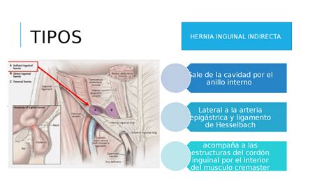 Infografía comparativa de diferentes tipos de soportes para hernia inguinal