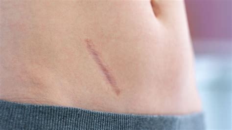 Primer plano de una cicatriz de liposucción bien curada.