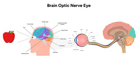 Diagrama del nervio óptico y su conexión con el cerebro, mostrando la zona afectada por la NAION