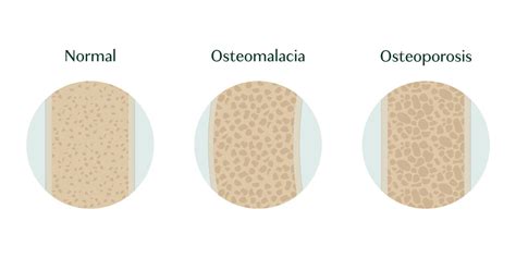 Gráfico comparativo entre osteomalacia y osteoporosis, destacando la mineralización y masa ósea.