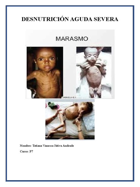 Representación visual de los cambios físicos asociados a la desnutrición severa, incluyendo la atrofia muscular y cambios en la piel.