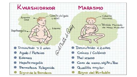 Infografía comparativa de las características del Marasmo y el Kwashiorkor.