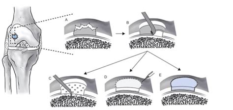 Diagrama que ilustra el proceso de microfracturas para la regeneración del cartílago.