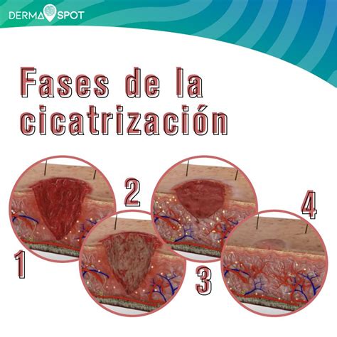 Infografía que ilustra las diferentes etapas de la cicatrización de una herida quirúrgica.