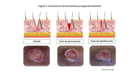 Gráfico que muestra la evolución de una cicatriz a lo largo del tiempo (de 0 a 18 meses).