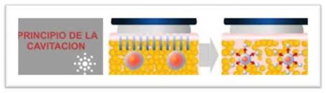 Diagrama explicativo del proceso de cavitación ultrasónica, mostrando la formación y colapso de burbujas en el tejido adiposo.