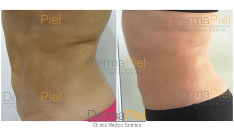 collage de imágenes mostrando antes y después de pacientes tratados con hidrolipoclasia en diferentes zonas del cuerpo.