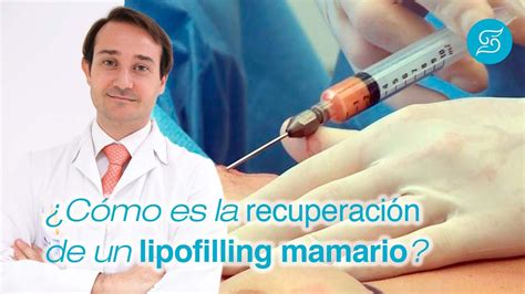 Infografía mostrando el proceso de lipofilling mamario: extracción de grasa y su infiltración en el pecho.