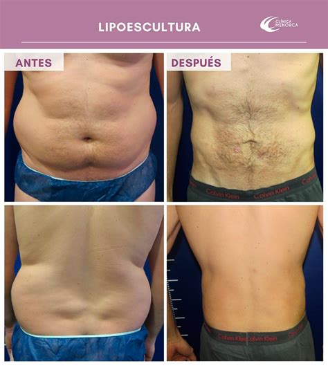 Infografía comparando antes y después de una liposucción, mostrando la reducción de volumen y la mejora del contorno corporal.