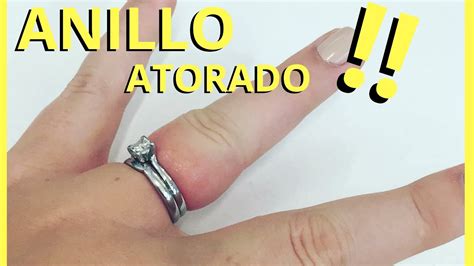 Ilustración de un dedo hinchado con un anillo atascado.