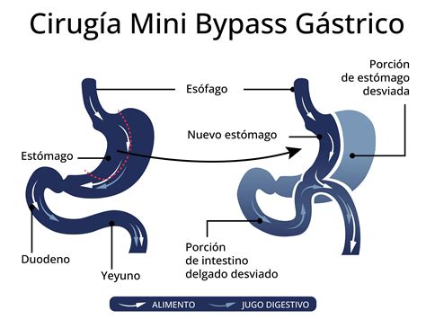 Diagrama esquemático del tracto digestivo superior mostrando los principales tipos de cirugía bariátrica: Bypass Gástrico en Y de Roux, Gastrectomía Vertical en Manga y Manga Gástrica.