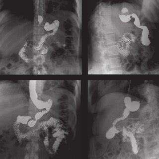 Estudio baritado de tubo digestivo alto en paciente con gastrectomía subtotal vertical, mostrando el estómago tubular y la línea de sutura.
