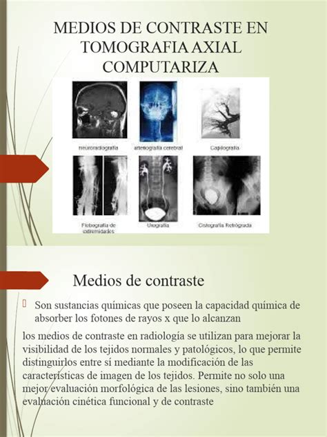 Ejemplo de filtración de medio de contraste en la línea de sutura de un remanente gástrico tras gastrectomía vertical, con hallazgos en tomografía computada.