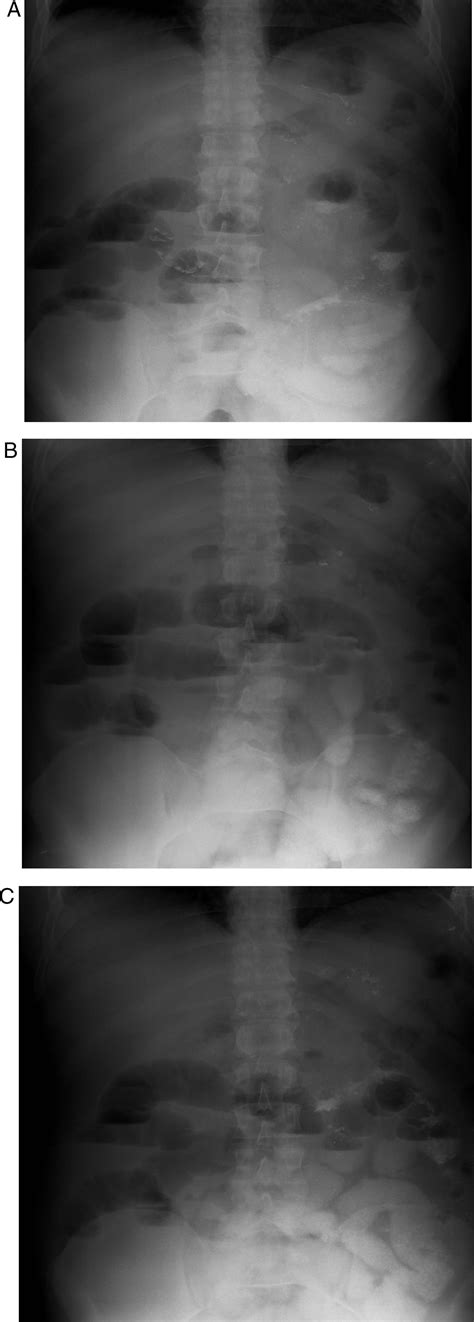 Estudio baritado mostrando dificultad al vaciamiento del remanente gástrico, con retención de contraste y dilatación de asas intestinales.